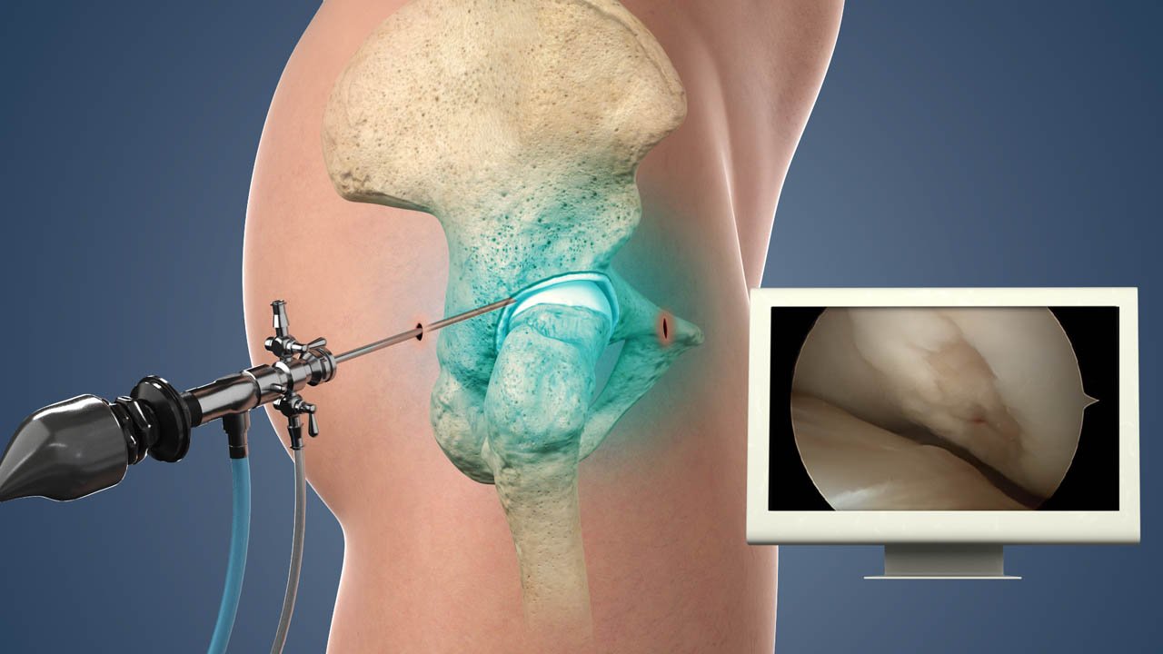 Hip Arthroscopy in Bangalore