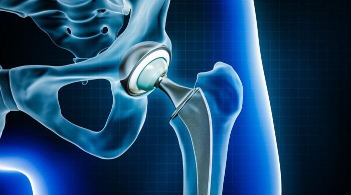 Hip Replacement in Bangalore