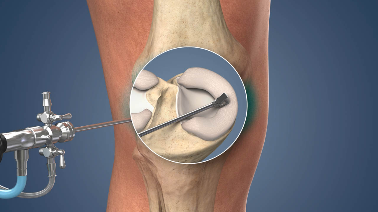 Knee Arthroscopy