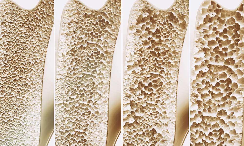 Osteoporosis Treatment in Bangalore