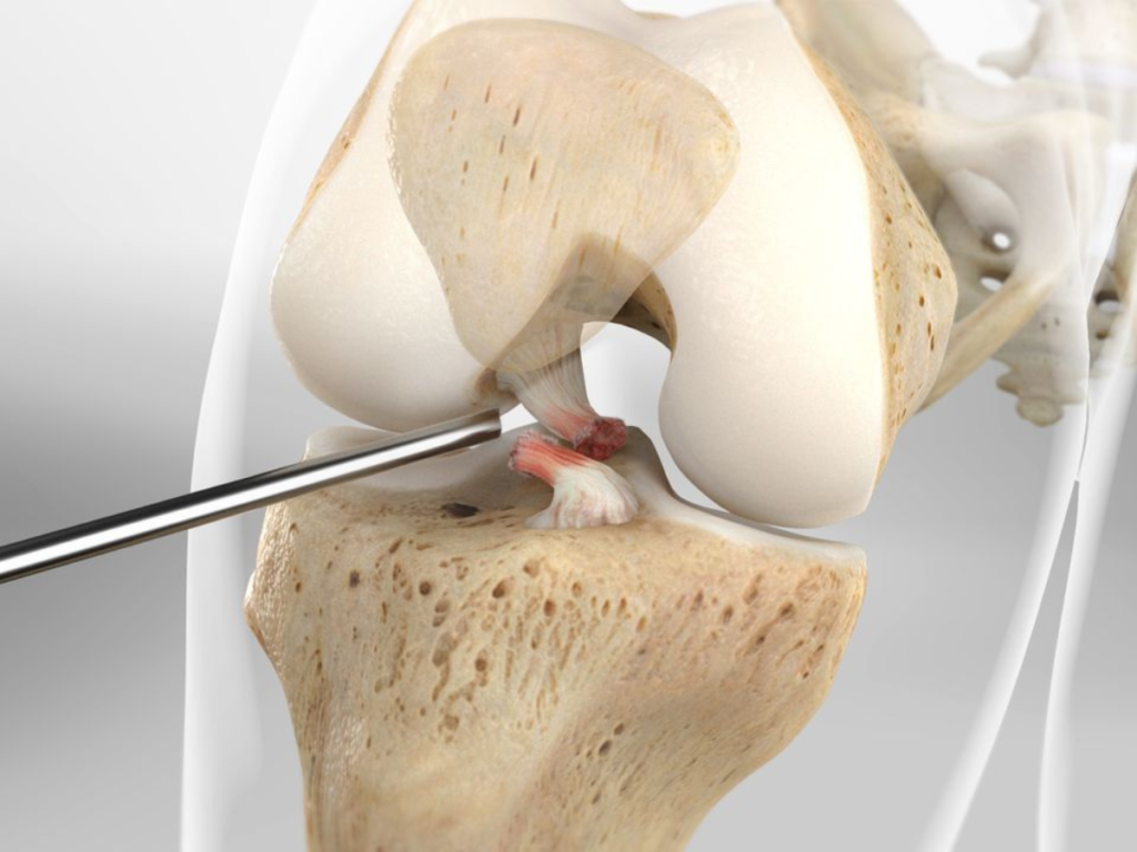 PCL Reconstruction Surgery in Bangalore