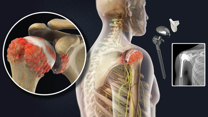 Shoulder Replacement Surgery in Bangalore